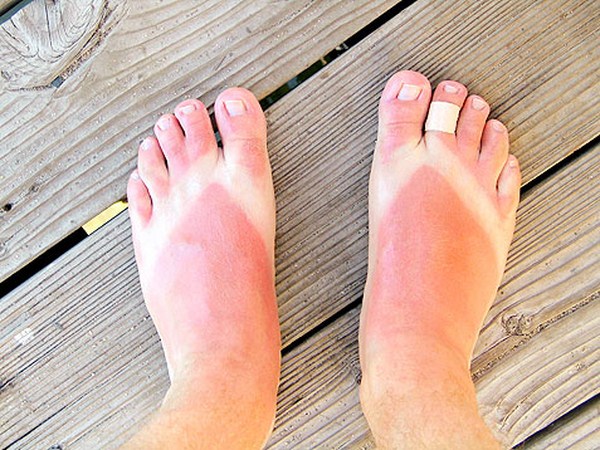 bad-sunburns-flip-flops-477 (Copy)