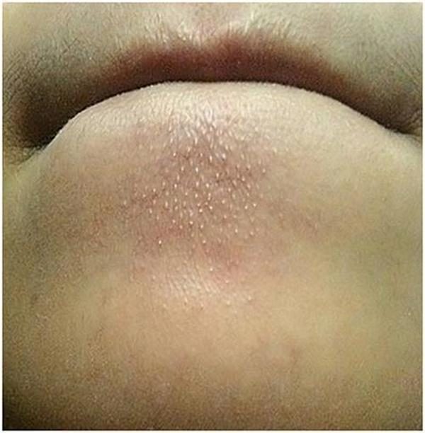 Chin-Blackheads-1