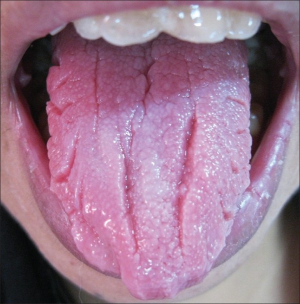 Fissured-Tongue-4