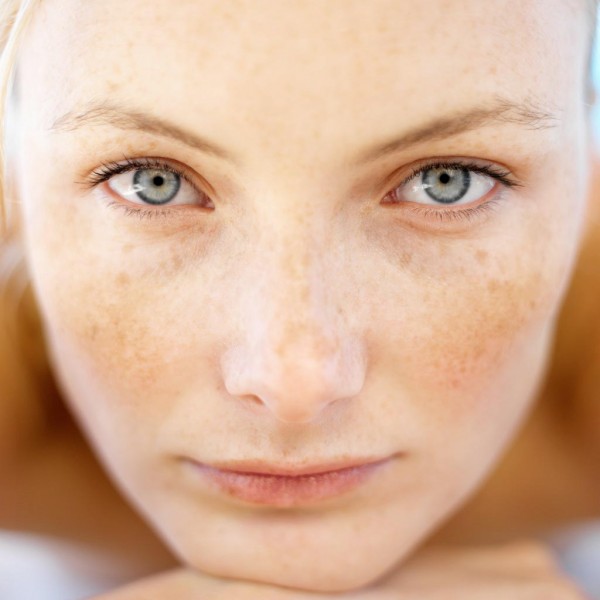 Melasma-natural-treatment-2