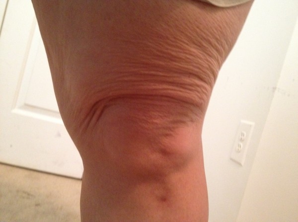 knee-skin