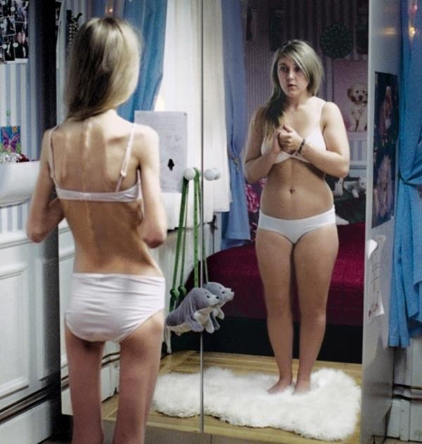 anorexic-pics-2