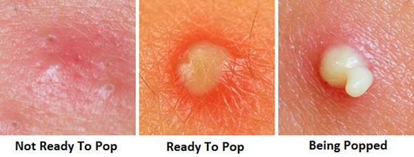 how-to-pop-a-pimple (Copy)