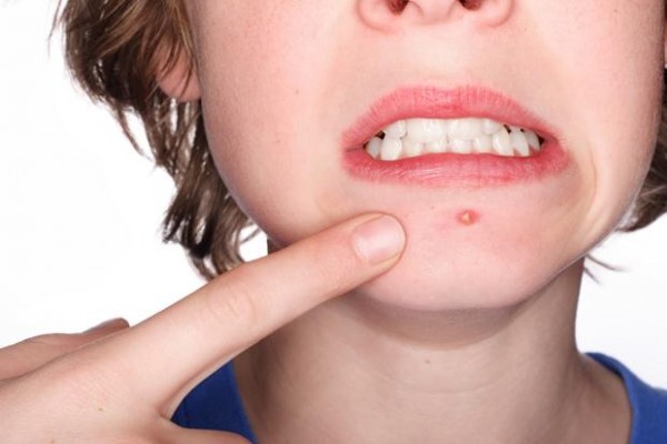 Some Factors That Cause Acne