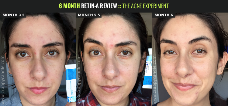 6month-retin-a-review-2