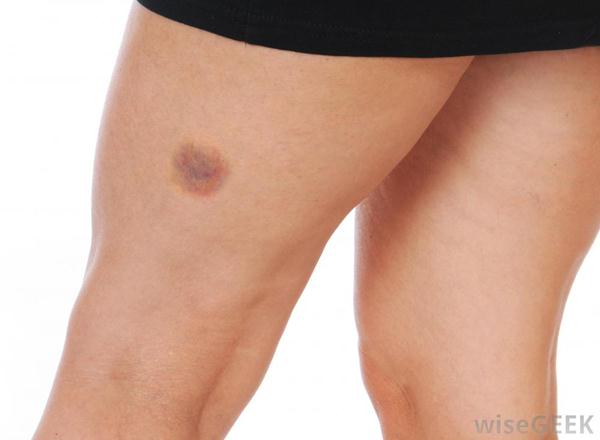 bruise-on-leg