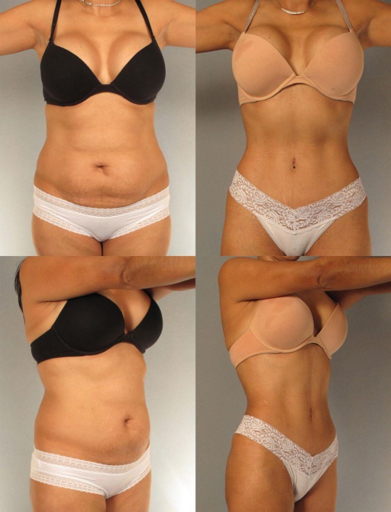 87462-tummy-tuck-houston.JPG_tmp