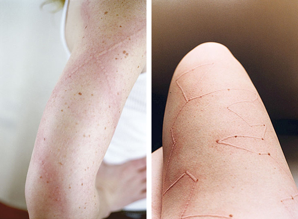 ariana-page-russell-dermatographia-skin-2