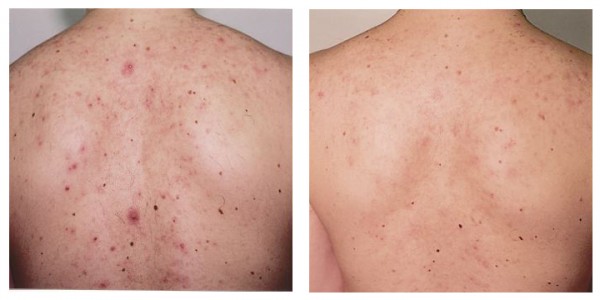 Microdermabrasion-back-acne1